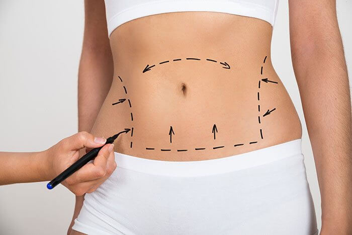Lipo Austin: Sculpting the Perfect Body with Dr. Andrew P. Trussler, MD